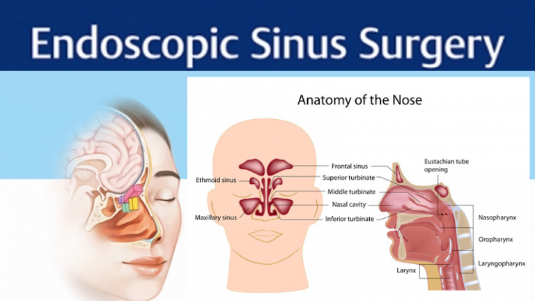 Functional Endoscopic Sinus Surgery Pranidhana