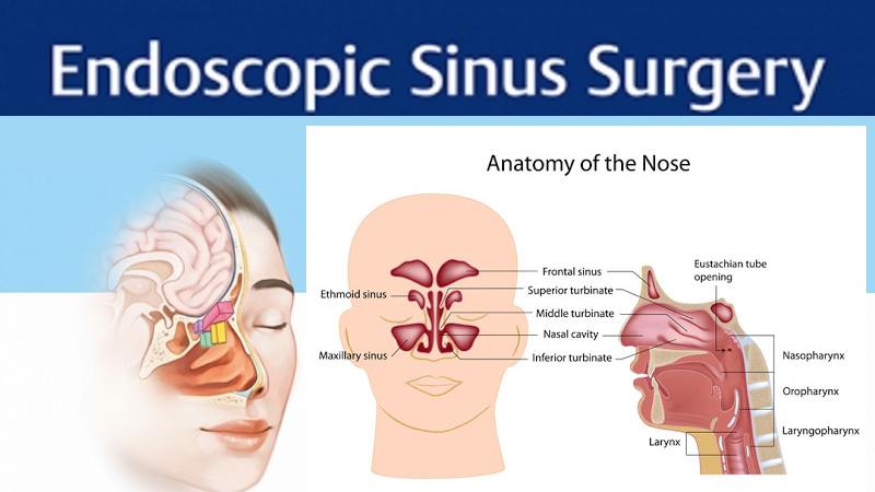 nasal sinus surgery