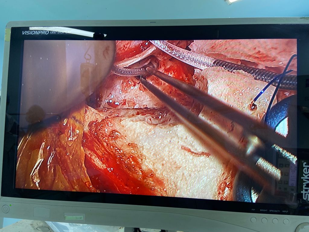 In- operative surgical images of the safe posterior tympanotomy technique