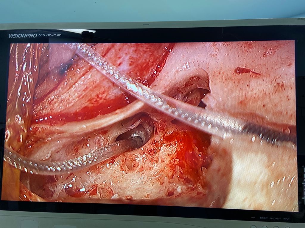 In- operative surgical images of the safe posterior tympanotomy technique